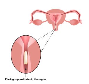 Diagram showing how suppositories for vaginal dryness are to be inserted